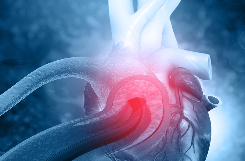 maze-procedure-for-atrial-fibrillation